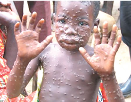 WHO considers emergency as mpox spreads to parts of Africa