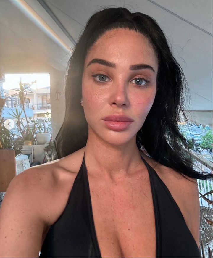 After an attack of Bell's Palsy at the age of 24, Tulisa battled chronic inflammation and swelling in her face