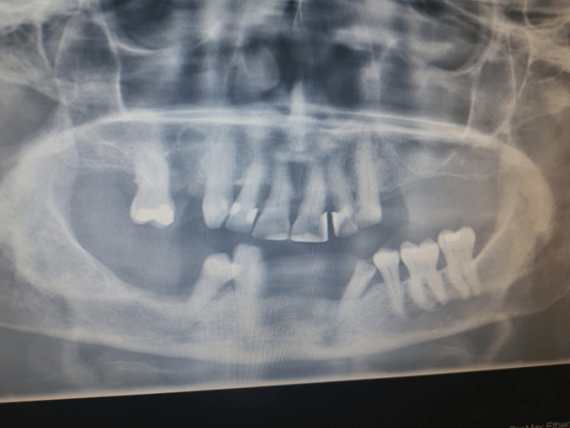 A scan of Hayley's teeth, before they were all removed