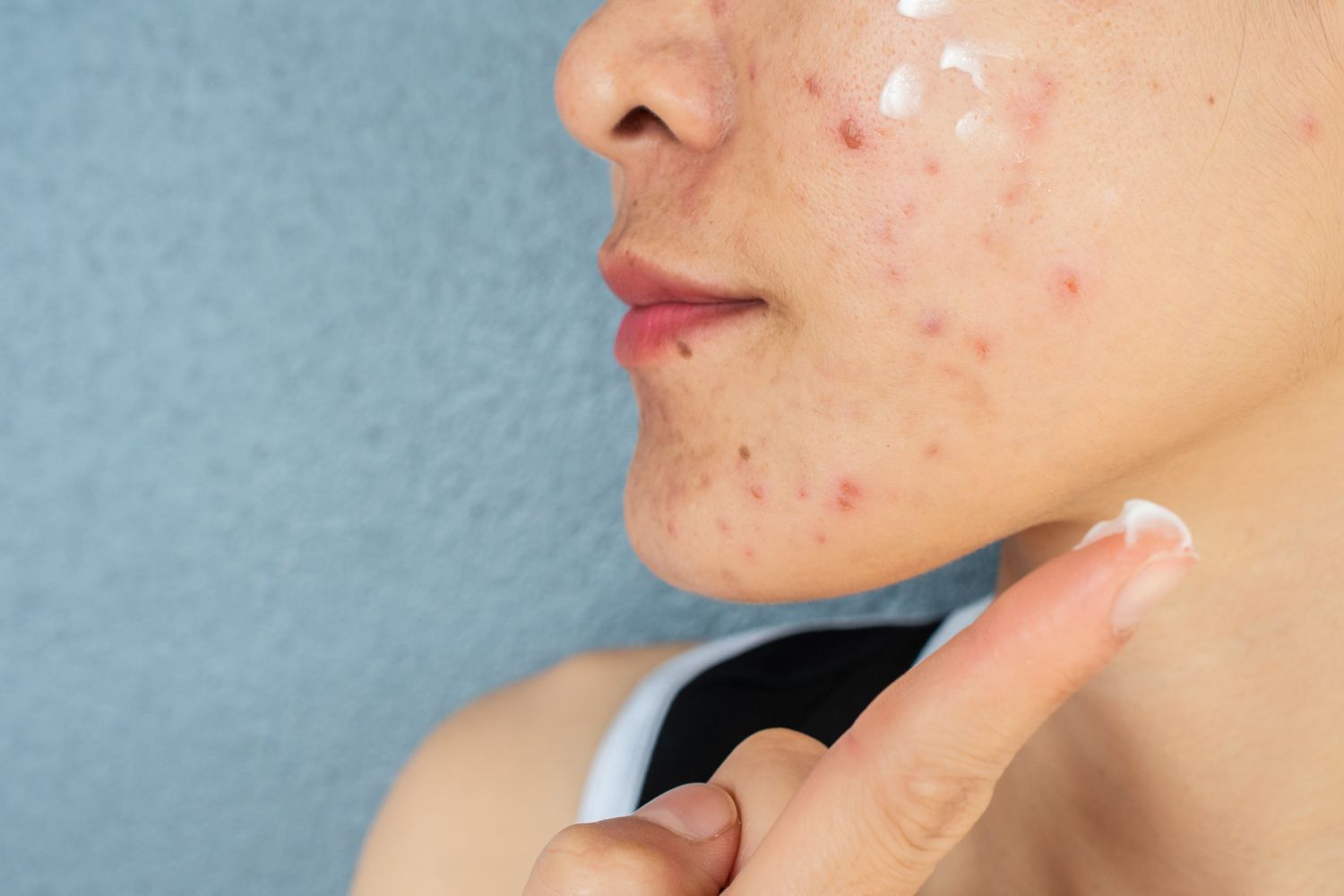 Acne Products May Release Benzene Even at Room Temperature, Study Shows