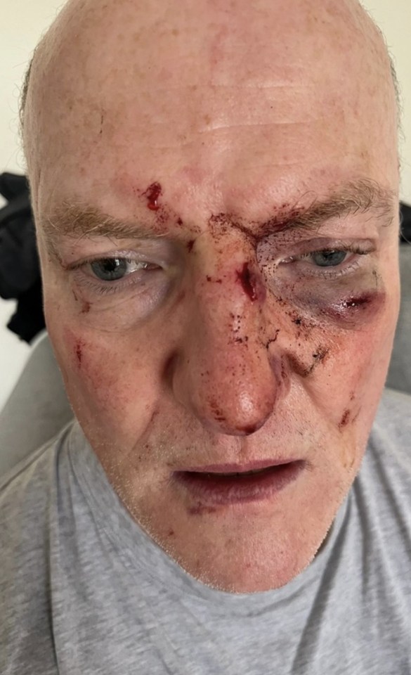 Michael Kelly has shared pictures of his injuries following the brawl which left him with a fractured eye socket