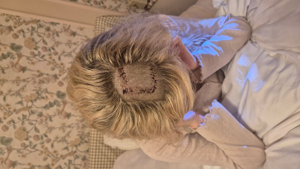 She underwent the same brain surgery Davina McCall after being diagnosed with a meningioma