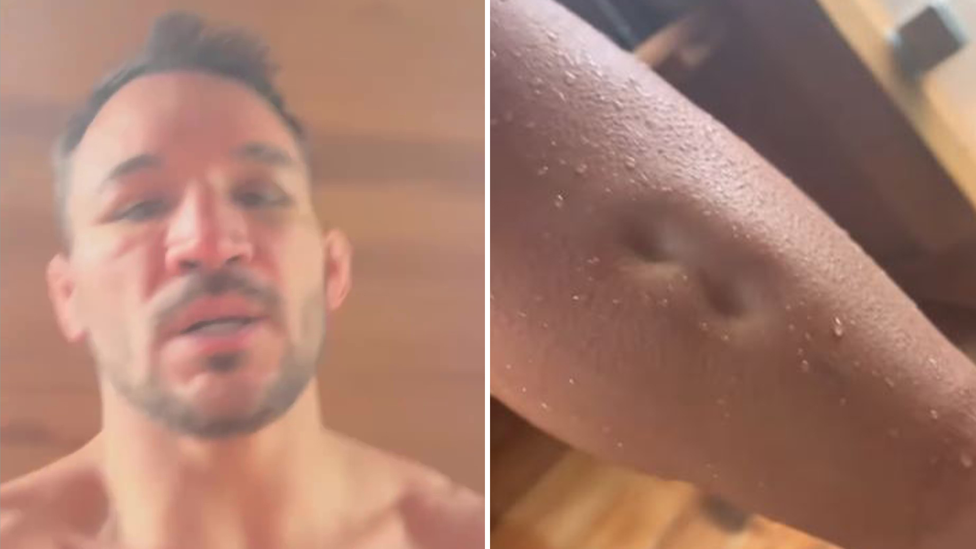 UFC star Michael Chandler shows off gruesome swelling on his legs with bizarre indents that don't disappear