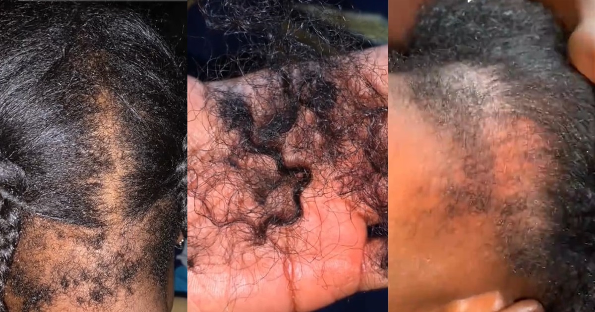 "My back hair is gone" – Lady l0ses hair after relaxing and braiding on the same day (WATCH)