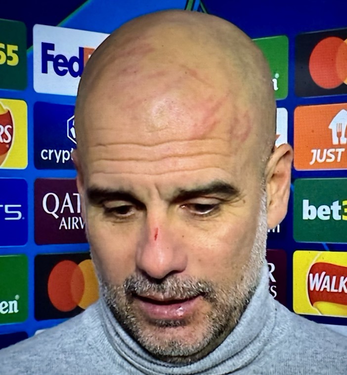 Guardiola sparked concern when he appeared after the 3-3 draw with Feyenoord with a cut on his nose and scratches on his face